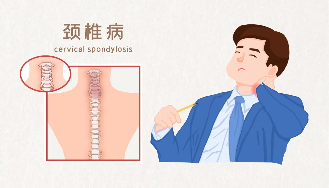 四种类型颈椎病，哪一种最不好惹 | 科普时间